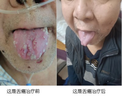 广西百色市杨忠雅治疗各种癌症有成就