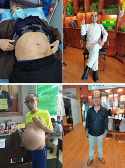 广西百色市杨忠雅治疗各种癌症有成就