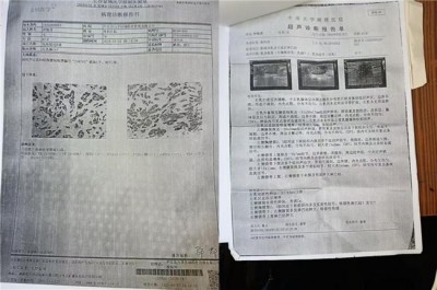 陈海林教授三焦气化法 ：开创乳腺癌治疗新路径